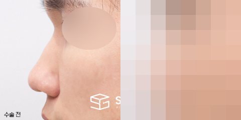 슈가성형외과 재) 코재수술 + 매부리 + 복코 + 기증늑 전후사진 - 45도 수술 전후 비교
