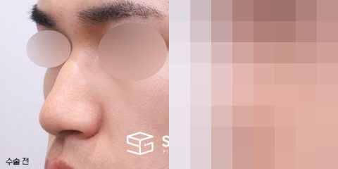 슈가성형외과 첫) 무보형물(코끝) + 매부리 + 복코 + 절골 + 비주 지지 + 비중격 연장 + 콧볼축소 + 근막 + 비중격 + 귀연골 전후사진 - 정면 수술 전후 비교