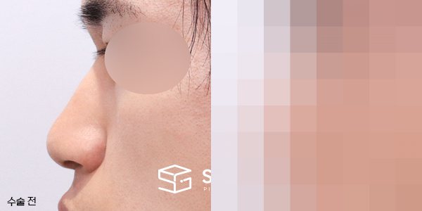 슈가성형외과 첫) 무보형물(코끝) + 매부리 + 복코 + 절골 + 비주 지지 + 비중격 연장 + 콧볼축소 + 근막 + 비중격 + 귀연골 전후사진 - 45도 수술 전후 비교
