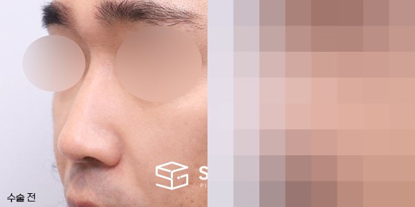 슈가성형외과 첫) 콧대코끝 + 매부리 + 휜코 + 절골 + 비중격 + 귀연골 전후사진 - 정면 수술 전후 비교