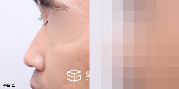 슈가성형외과 첫) 콧대코끝 + 매부리 + 휜코 + 절골 + 비중격 + 귀연골 전후사진 - 45도 수술 전후 비교