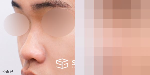슈가성형외과 첫) 콧대 + 코끝 + 복코 + 비순각 교정 + 자가늑 전후사진 - 정면 수술 전후 비교