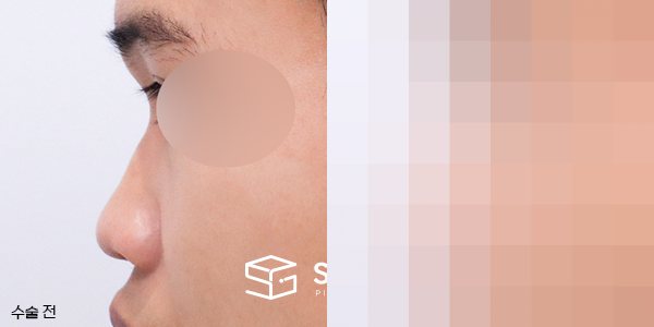 슈가성형외과 첫) 콧대 + 코끝 + 복코 + 비순각 교정 + 자가늑 전후사진 - 45도 수술 전후 비교