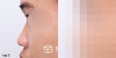 슈가성형외과 첫) 콧대 + 코끝 + 복코 + 비순각 교정 + 자가늑 전후사진 - 45도 수술 전후 비교
