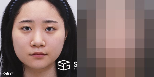 슈가성형외과 첫) 콧대+코끝+비중격+귀연골+복코교정+콧볼축소+얼굴지방흡입+이중턱지방흡입+사각턱보톡스 전후사진 - 정면 수술 전후 비교