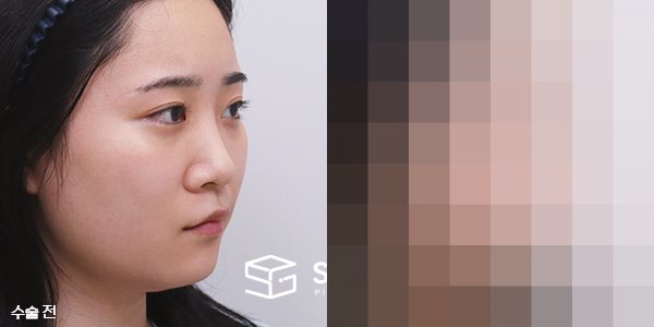 슈가성형외과 첫) 콧대+코끝+비중격+귀연골+복코교정+콧볼축소+얼굴지방흡입+이중턱지방흡입+사각턱보톡스 전후사진 - 45도 수술 전후 비교