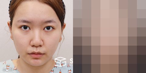 슈가성형외과 첫) 콧대+코끝+비중격+귀연골+복코교정+이중턱지방흡입 전후사진 - 정면 수술 전후 비교