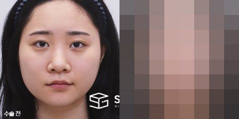 슈가성형외과 첫) 콧대+코끝+비중격+귀연골+복코교정+콧볼축소+얼굴지방흡입+이중턱지방흡입+사각턱보톡스 전후사진 - 정면 수술 전후 비교