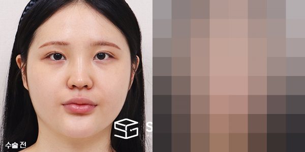 슈가성형외과 첫) 콧대+코끝+절골술+매부리+비중격+이중턱지방흡입 전후사진 - 정면 수술 전후 비교