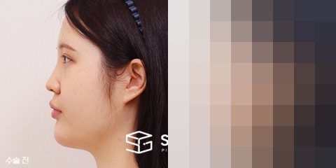 슈가성형외과 첫) 콧대+코끝+절골술+매부리+비중격+이중턱지방흡입 전후사진 - 45도 수술 전후 비교