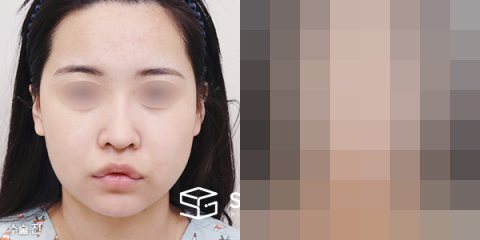 슈가성형외과 첫) 얼굴지방이식+이중턱지방흡입+심부볼제거+턱보톡스 전후사진 - 정면 수술 전후 비교