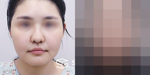 슈가성형외과 첫) 콧대+코끝+복코+비주지지+귀연골+얼굴지방흡입+민트실리프팅+입술필러+입꼬리보톡스+턱보톡스 전후사진 - 정면 수술 전후 비교