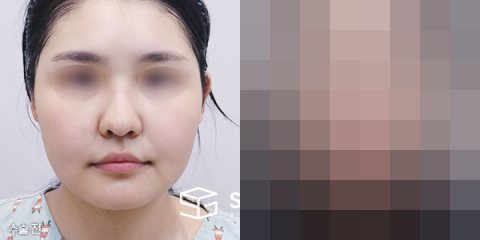 슈가성형외과 첫) 콧대+코끝+복코+비주지지+귀연골+얼굴지방흡입+민트실리프팅+입술필러+입꼬리보톡스+턱보톡스 전후사진 - 정면 수술 전후 비교