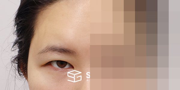 슈가성형외과 재) 이마거상+자연유착재수술+뒤트임+밑트임 전후사진 - 정면 수술 전후 비교