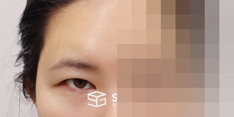 슈가성형외과 재) 이마거상+자연유착재수술+뒤트임+밑트임 전후사진 - 정면 수술 전후 비교