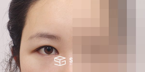 슈가성형외과 재) 이마거상+자연유착재수술+뒤트임+밑트임 전후사진 - 45도 수술 전후 비교