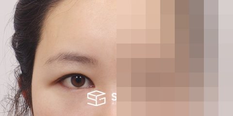 슈가성형외과 재) 이마거상+자연유착재수술+뒤트임+밑트임 전후사진 - 45도 수술 전후 비교