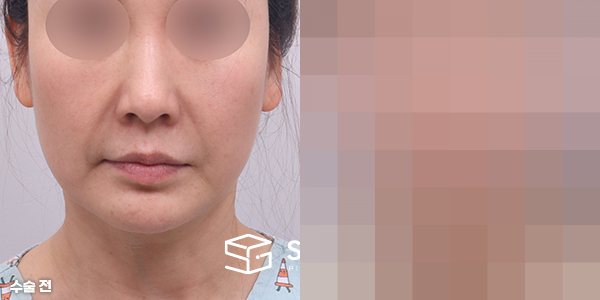 슈가성형외과 첫) 실리프팅 전후사진 - 정면 수술 전후 비교