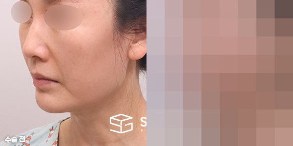 슈가성형외과 첫) 실리프팅 전후사진 - 45도 수술 전후 비교