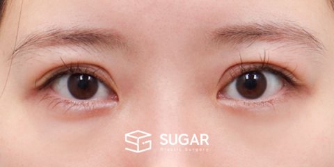 슈가성형외과 재) 재수술 + 절개 + 윗트임 + 뒤밑트임 전후사진 - 수술 전