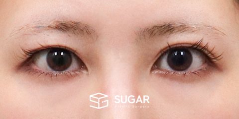 슈가성형외과 재) 재수술 + 절개 + 이마거상 전후사진 - 수술 전