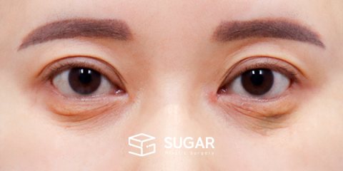 슈가성형외과 재) 재수술 + 중안부면부 거상 + 하안검 + 절개 + 눈매교정 전후사진 - 수술 전