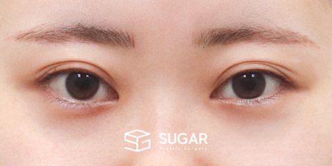슈가성형외과 첫) 자연유착 + 눈매교정 + 뒤밑트임 전후사진 - 수술 전