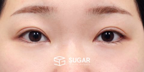 슈가성형외과 첫) 뒤밑트임 전후사진 - 수술 전