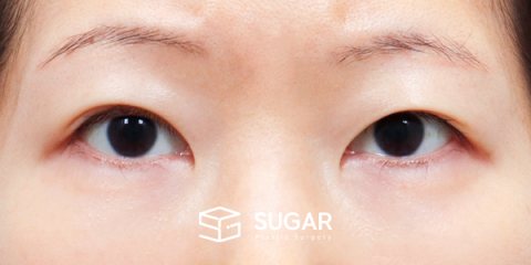 슈가성형외과 첫) 자연유착 + 눈매교정 + 윗트임 전후사진 - 수술 전