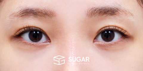 슈가성형외과 첫) 뒤밑트임 전후사진 - 수술 전