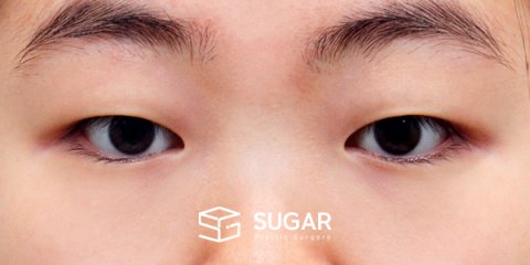 슈가성형외과 첫) 자연유착 + 눈 위 지방 제거 + 윗트임 전후사진 - 수술 전