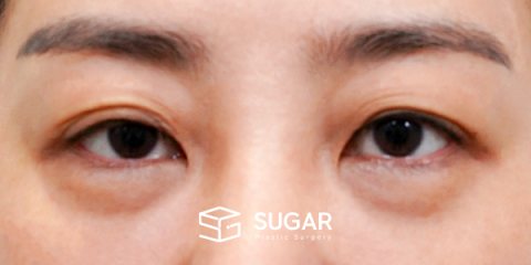 슈가성형외과 첫) 눈썹 거상 + 중안면부 거상 + 하안검 + 자연유착 전후사진 - 수술 전