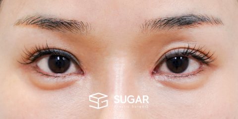 슈가성형외과 첫) 뒤밑트임 전후사진 - 수술 전