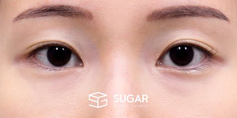 슈가성형외과 재) 재수술 + 자연유착 + 눈매교정 + 뒤밑트임 전후사진 - 수술 전