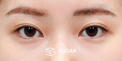 슈가성형외과 재) 재수술 + 뒤밑트임 전후사진 - 수술 전