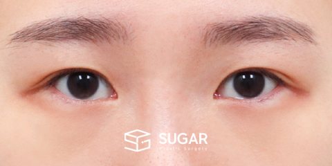 슈가성형외과 첫) 뒤밑트임 전후사진 - 수술 전