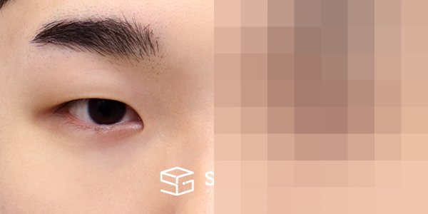 슈가성형외과 첫) 자연유착 + 눈매교정 + 앞트임 + 뒤밑트임 전후사진 - 정면 수술 전후 비교