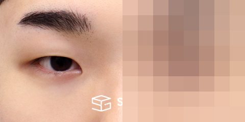 슈가성형외과 첫) 자연유착 + 눈매교정 + 앞트임 + 뒤밑트임 전후사진 - 정면 수술 전후 비교