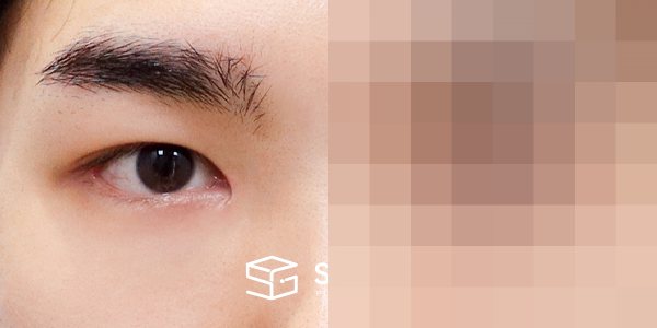 슈가성형외과 첫) 자연유착 + 눈매교정 + 앞트임 + 뒤밑트임 전후사진 - 45도 수술 전후 비교