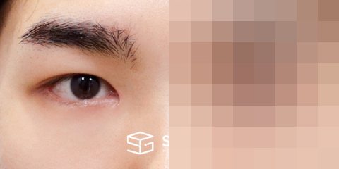 슈가성형외과 첫) 자연유착 + 눈매교정 + 앞트임 + 뒤밑트임 전후사진 - 45도 수술 전후 비교
