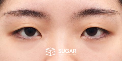 슈가성형외과 첫) 자연유착 + 눈매교정 + 앞트임 전후사진 - 수술 전