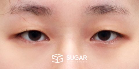 슈가성형외과 첫) 자연유착 + 눈매교정 전후사진 - 수술 전