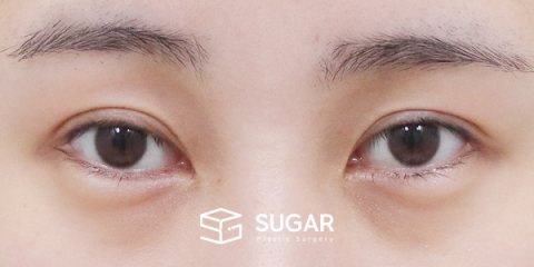 슈가성형외과 첫) 눈 밑 지방재배치 + 뒤밑트임 전후사진 - 수술 전