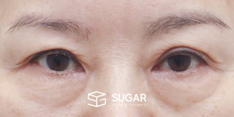 슈가성형외과 첫) 중안면부 거상 + 하안검 전후사진 - 수술 전