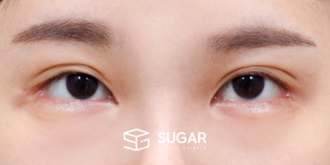슈가성형외과 첫) 절개(두 줄 따기) + 눈매교정 + 2Point 뒤밑트임 전후사진 - 수술 전