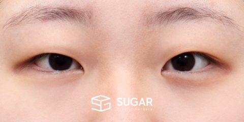 슈가성형외과 첫) 절개 + 눈매교정 + 앞트임 + 윗트임 + 눈 위 지방 제거 전후사진 - 수술 전
