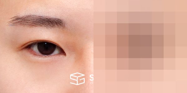 슈가성형외과 첫) 절개 + 앞트임 + 뒤밑트임 전후사진 - 정면 수술 전후 비교