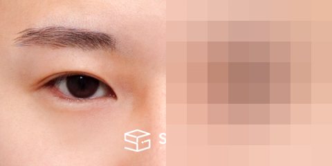 슈가성형외과 첫) 절개 + 앞트임 + 뒤밑트임 전후사진 - 정면 수술 전후 비교