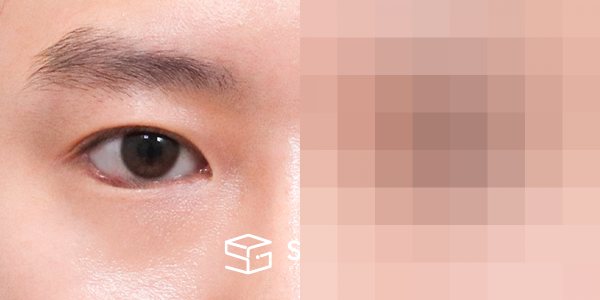 슈가성형외과 첫) 절개 + 앞트임 + 뒤밑트임 전후사진 - 45도 수술 전후 비교