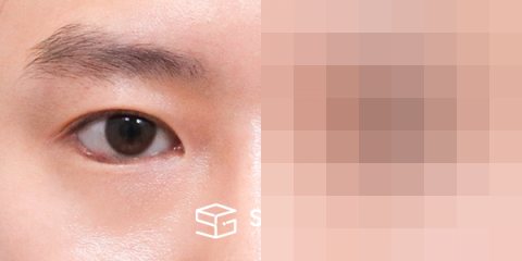 슈가성형외과 첫) 절개 + 앞트임 + 뒤밑트임 전후사진 - 45도 수술 전후 비교